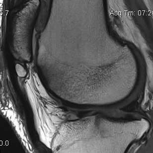 Patella Tendon Calcification MRI